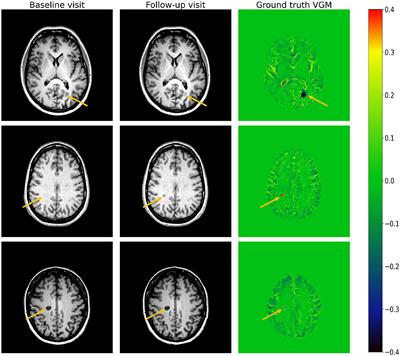 A generalizable deep voxel-guided morphometry algorithm for the detection of subtle lesion dynamics in multiple sclerosis